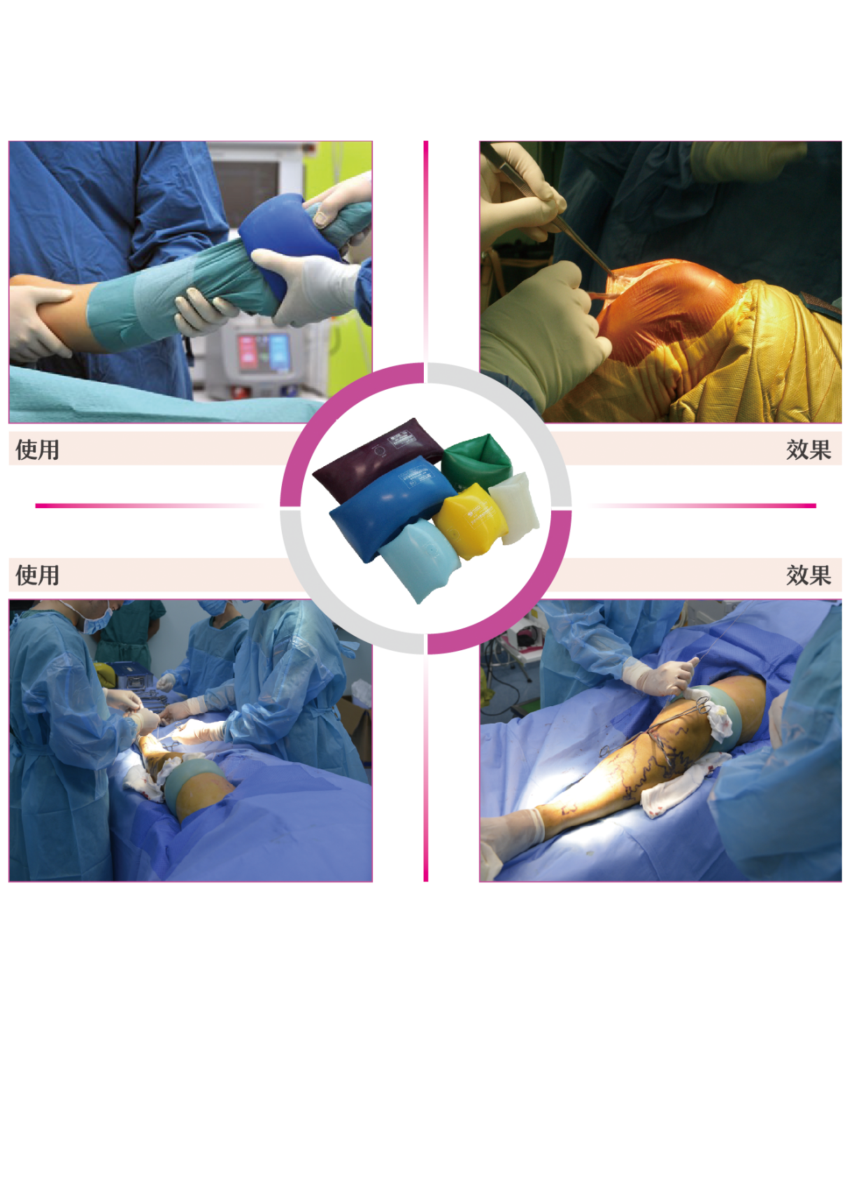 驅(qū)血器（肢體壓力套）：主要針對(duì)手術(shù)室的產(chǎn)品。